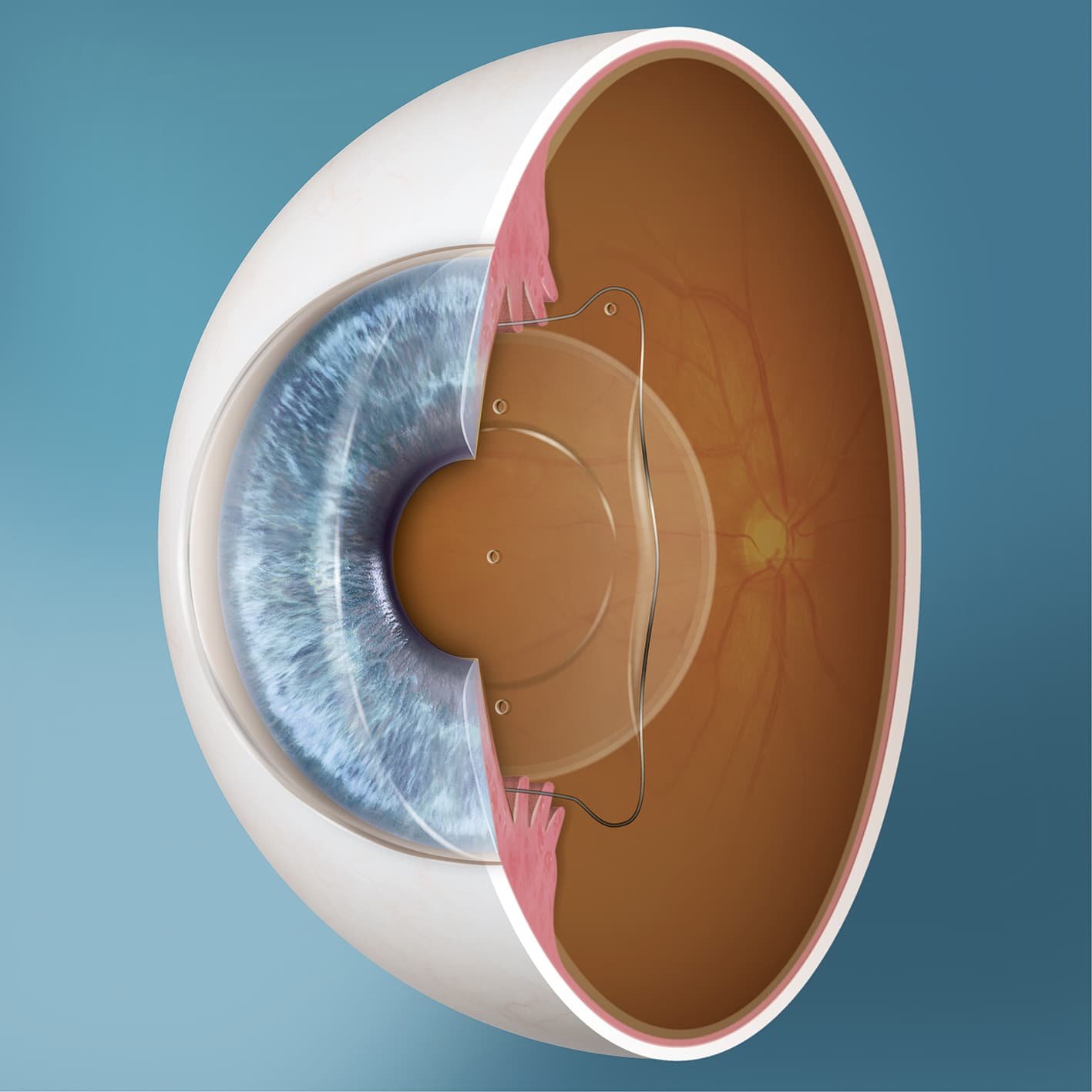 ICL eye surgery diagram showing implantable collamer lens placement inside the eye for vision correction in India